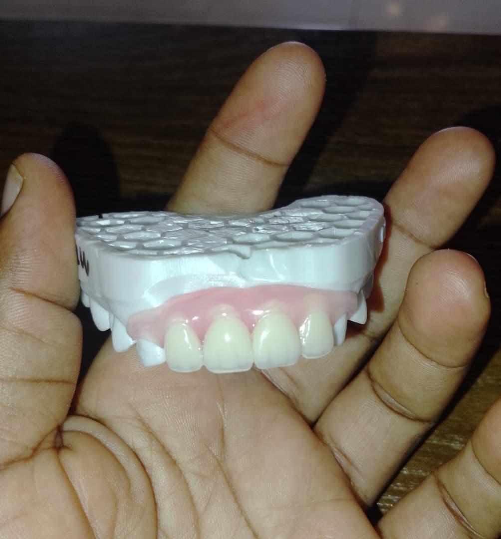 Prothèse amovible en Valplast de quatre éléments